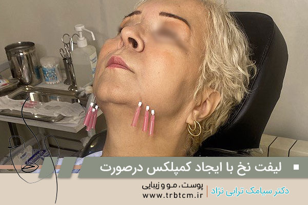 ابفت با نخ در تهران