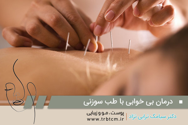 درمان بی خوابی با طب سوزنی