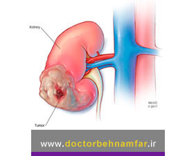 سرطان کلیه چه بیماری است و چگونه درمان میشود؟