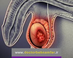 بیماری سرطان بیضه چیست؟