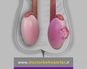 بدخیمی بیضه شایع ترین سرطان در مردان جوان