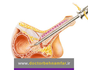 جراحی سرطان پروستات در چه مواقعی انجام میشود؟