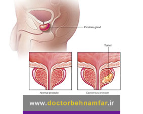 سرطان پروستات چه عوارضی دارد؟