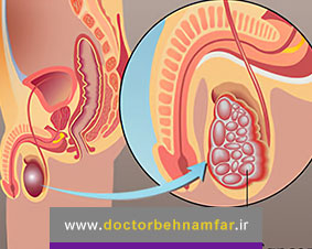 آیا هر توده ای در بیضه سرطان است؟