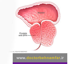 بزرگی پروستات چه علائمی دارد؟