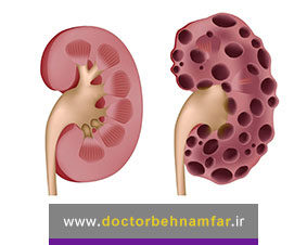 کلیه پلی کیستیک چیست و چگونه تشخیص داده می شود؟