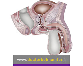 علل و علائم تنگی مجرای ادرار در مردان