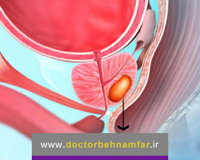 عمل جراحی پروستاتکتومی چیست؟