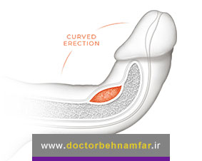 علت کج شدن آلت تناسلی مردان چیست؟