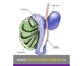 کیست اپیدیدیم یا اسپرماتوسل چیست و چگونه درمان می شود؟