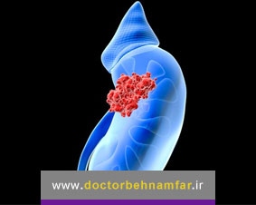 سرطان حالب چیست؟ علائم و روشهای درمان تومور حالب