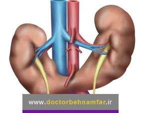 کلیه نعل اسبی یا فیوژن کلیه چیست؟