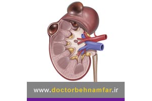 علت به وجود آمدن کیست کلیه