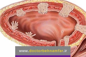 درمان سرطان مثانه با ایمونوتراپی