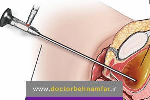 مراقبت قبل و بعد از سیستوسکوپی
