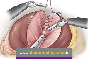 آیا روش جراحی، برای درمان سرطان کلیه مناسب است؟