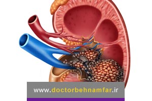 سرطان کلیه و تشخیص زودهنگام آن