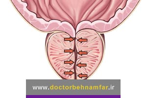 آیا بزرگی خوش خیم پروستات می تواند به سرطان تبدیل شود؟