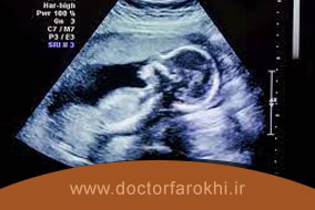 سونوگرافی تعیین جنسیت در دوران بارداری