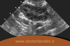 تشخیص سندروم تخمدان پلی کیستیک با سونوگرافی رحم