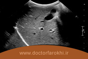 سونوگرافی شکمی برای تشخیص سل شکمی یا سل منتشر