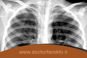 آیا آسم با رادیولوژی تشخیص داده میشود؟
