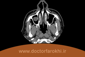 تشخیص کیست سینوس های فک و صورت با رادیوگرافی سینوس