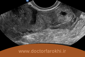 تشخیص حاملگی خارج از رحم با سونوگرافی
