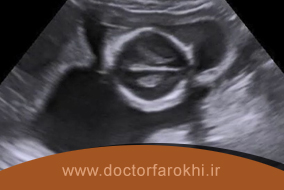 محاسبه سن بارداری با سونوگرافی چگونه انجام میشود؟