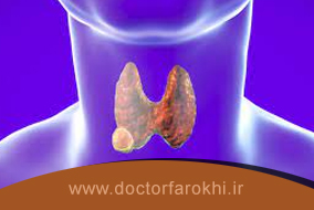 علائم ندول خوش خیم تیروئید در سونوگرافی