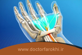سندرم تونل کارپال چیست؟ علل علائم و درمان سندرم تونل کارپال
