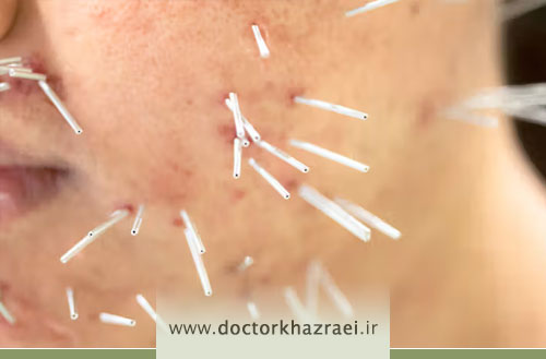 درمان لک های پوستی صورت توسط متخصص طب سوزنی