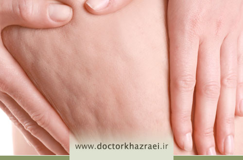 طب سوزنی برای درمان و رفع سلولیت؛ پاسخ به سوالات رایج
