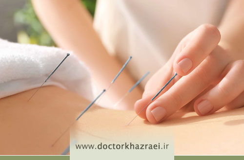 درمان اندومتریوز با طب سوزنی؛ راهی طبیعی برای کاهش درد