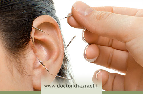طب سوزنی گوش؛ کاربردها، فواید و نقاط طب سوزنی روی گوش