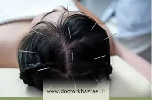 طب سوزنی سر؛ فواید، نحوه انجام و نقاط طب سوزنی در سر
