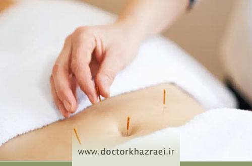 تاثیر و فواید طب سوزنی برای لاغری