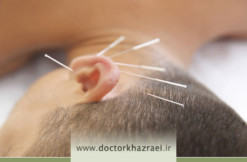 لاغری با طب سوزنی گوش؛ روشی متفاوت برای کنترل اشتها و کاهش وزن