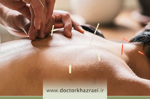 طب سوزنی در غرب تهران: راهنمای کامل + فواید، نحوه انجام و هزینه