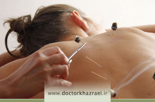 طب سوزنی و لاغری موضعی؛ روشی ایمن و بدون عوارض برای فرم دهی بدن