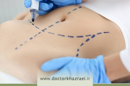 لاغری شکم و پهلو با طب سوزنی؛ راهی طبیعی برای کاهش چربی های مقاوم