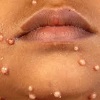 مولوسکوم عفونی (Molluscum contagiosum)
