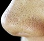 جوش های سر سیاه بینی