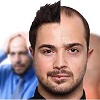 به افراد مختلف در مورد ریزش مو و کاشت مو بصورت شخصی و فردی نگاه کنید