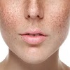 لک های پوستی مادرزادی
