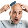 کاشت موی طبیعی و اسامی متفاوت آن در کلینیک های مختلف