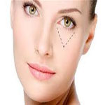 رفع گودی درچشم,گونه گذاری وبرطرف کردن لاغری صورت