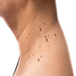 تگ های پوستی Skin tag