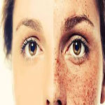 ليزر در برطرف كردن كک مک های پوست موثر است