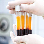 PRP( پی ار پی به تنهايي وهمراه تزريق چربي